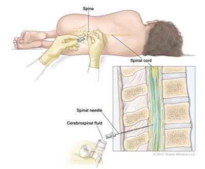 Collecting CSF for examination