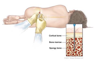 Taking a bone marrow sample